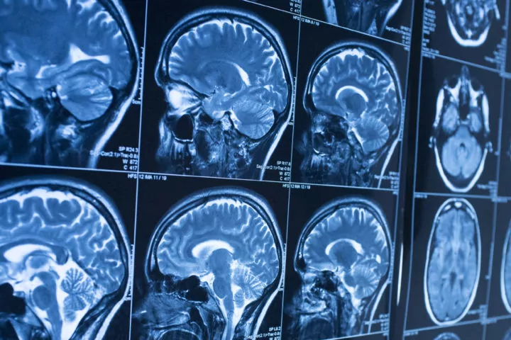 traumatic brain injuries caused by damaged brain tissue
